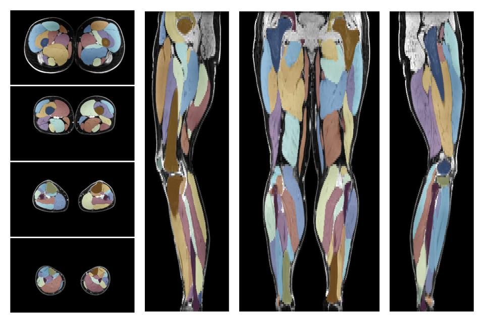 Overlay of automated muscle segmentation labels on dixon water image.